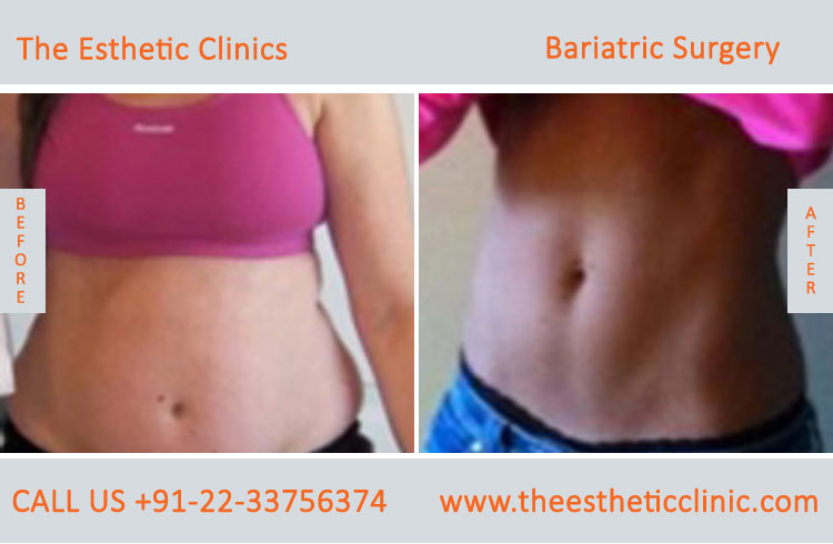Bariatric Surgery, Weight Loss Surgery before after photos in mumbai india (1)